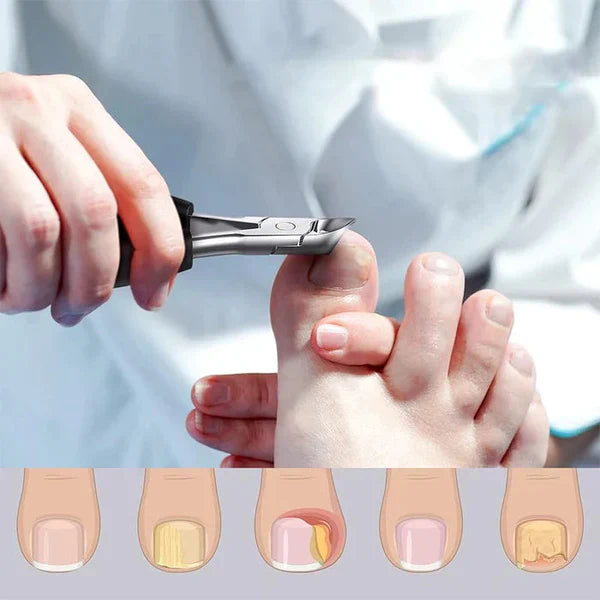 NailCare Pro™ - Toe Nail Cutter