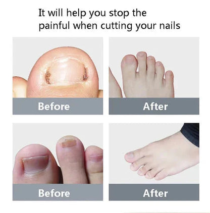 NailCare Pro™ - Toe Nail Cutter